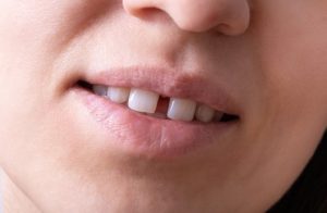 Почему образуется щель между зубами